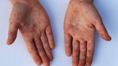 Photo of Viruela del mono en la Argentina: cuáles son los síntomas de la variante Mpox Clado Ib